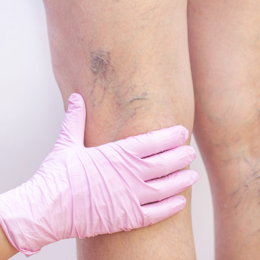 Female legs with varicose veins. At the doctors surgeons appointment. doctors hands in gloves. Concept of human health and disease. Vascular diseases, problems of varicose veins