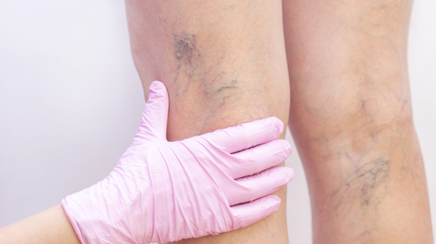 Female legs with varicose veins. At the doctors surgeons appointment. doctors hands in gloves. Concept of human health and disease. Vascular diseases, problems of varicose veins