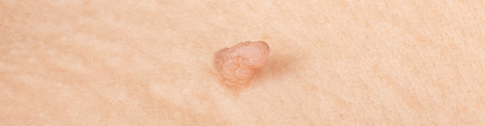 papilloma close up, big birthmark on the skin.